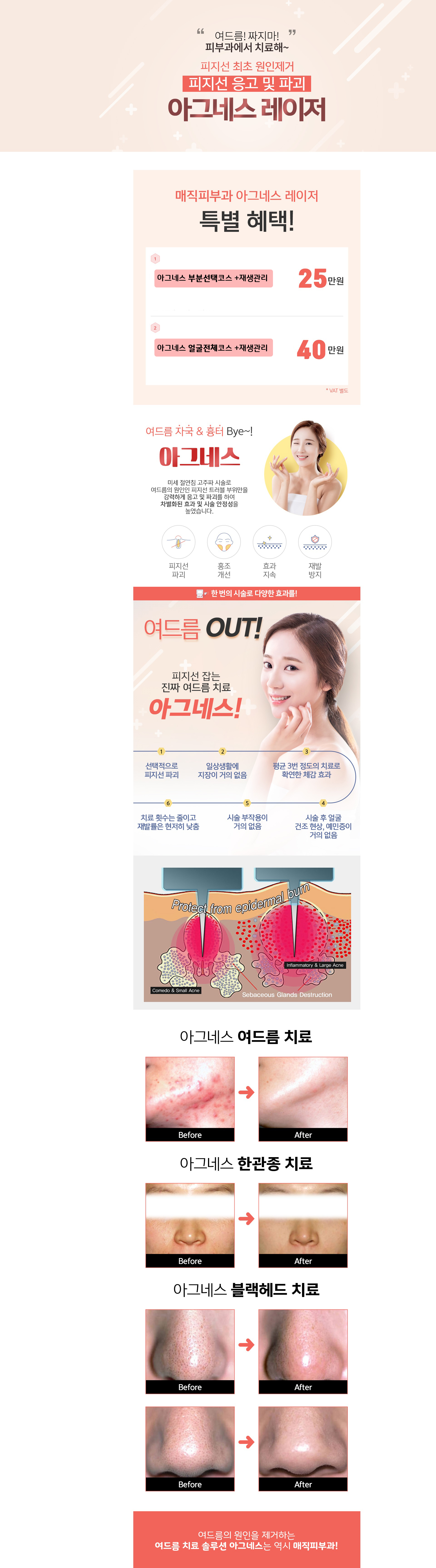 아그네스레이저